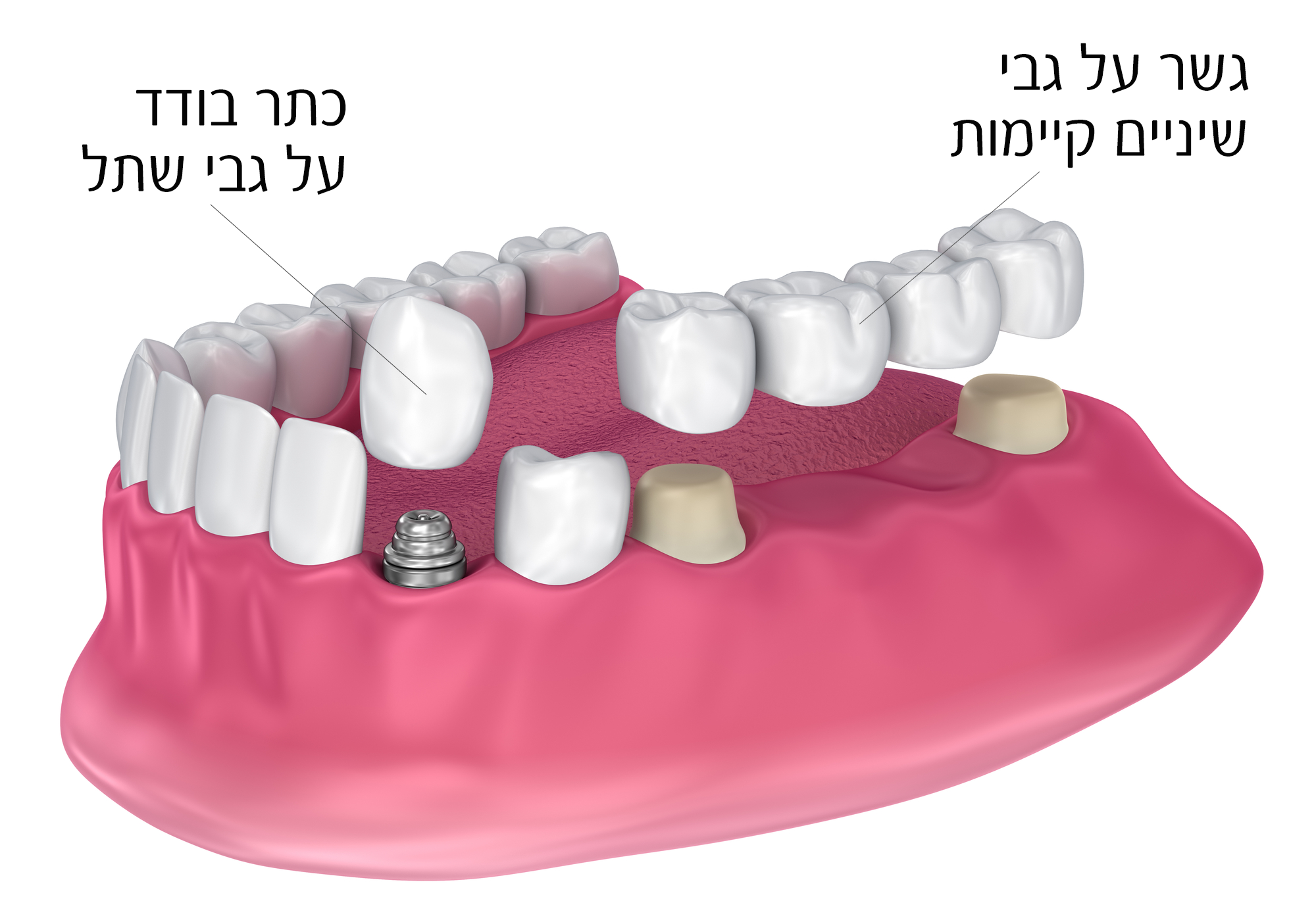 שיקום שיניים באמצעות כתרים וגשרים