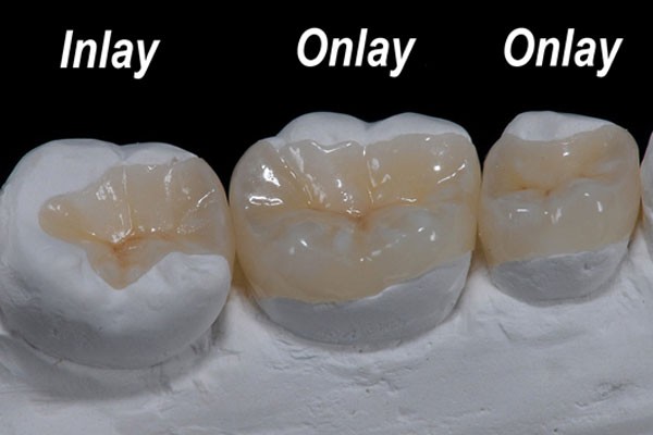 השלמת כותרת השן באמצעות מילואת חרסינה Inlay\Onlay