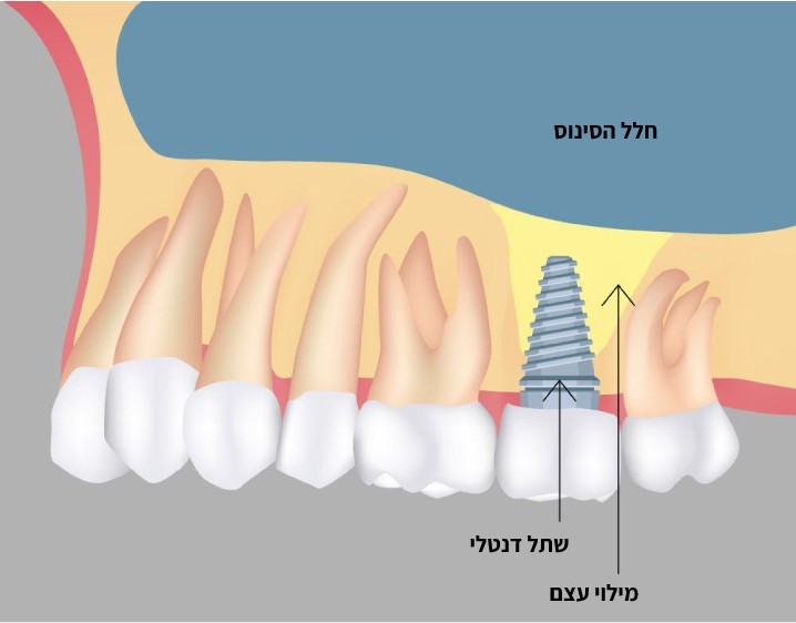 הרמת סינוס לצורך התקנת שתלים